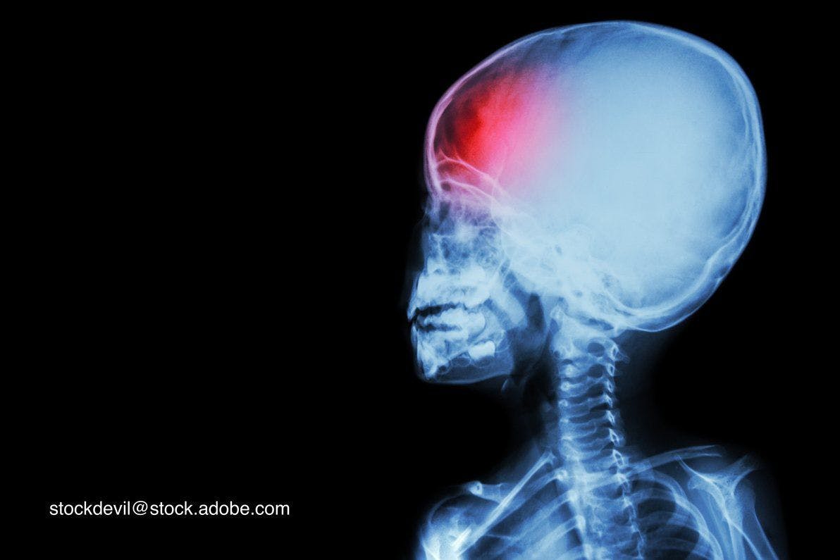 image of a scan of a child with a headache