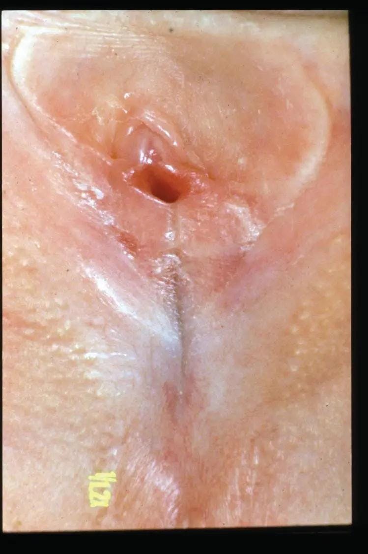 FIGURE 3. Labial adhesions. (Reported in: Emans SJ, et al. Emans, Laufer, Goldstein’s Pediatric & Adolescent Gynecology. 7th ed. Figure 14-13 (B), page 189, Philadelphia, Wolters Kluwer, 2020).