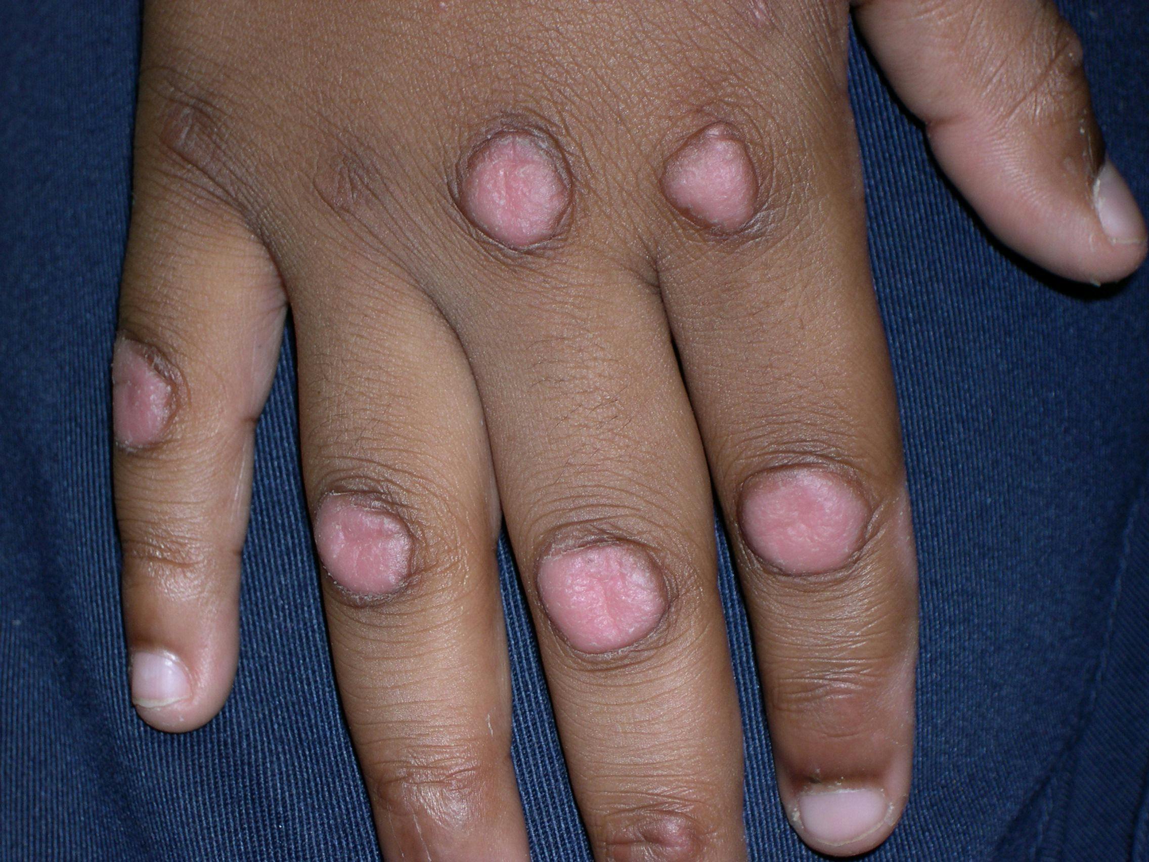 child with knuckle pads