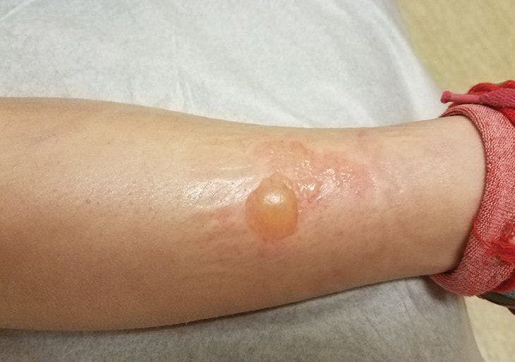 blistering on leg as a result of a burn
