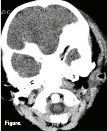 Suspicious facial swelling in a 22-month-old girl | Image Credit: © author provided - © author provided - stock.adobe.com.