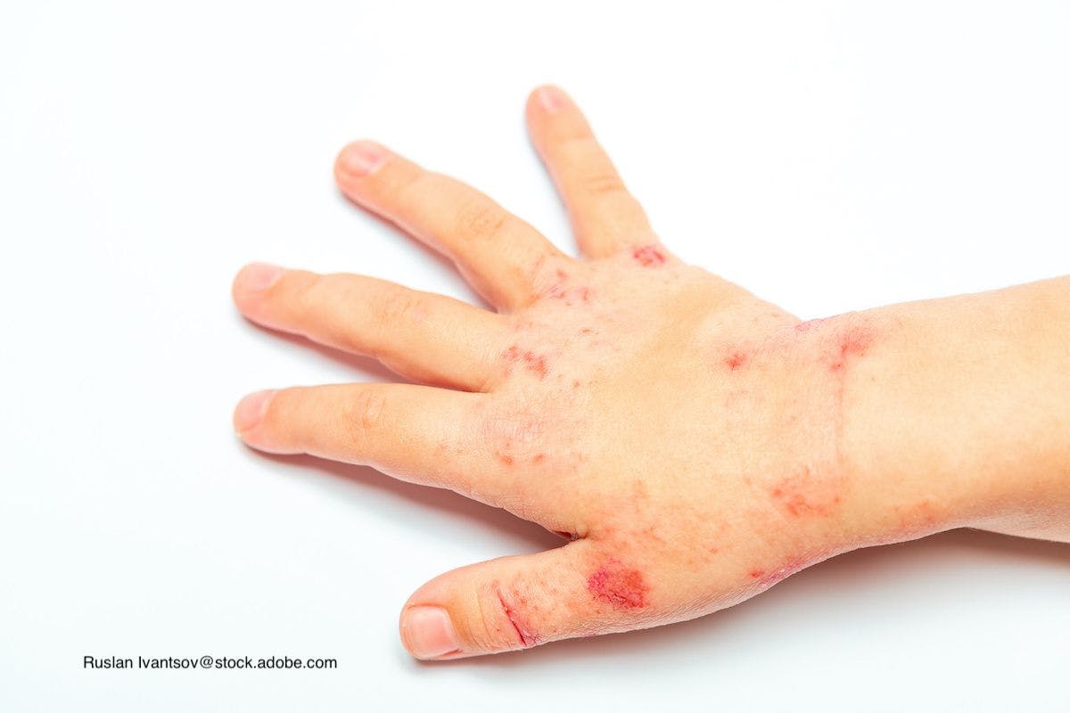Examining the risk of mental disorders in patients with atopic dermatitis