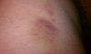 Unexplained Bruising in a Teenager: Abuse-or Mimic?