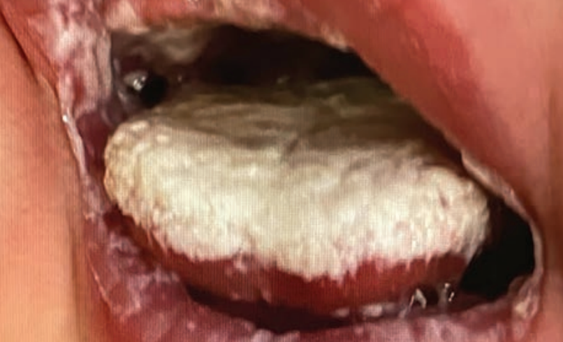 White oral lesions in neonate with COVID-19