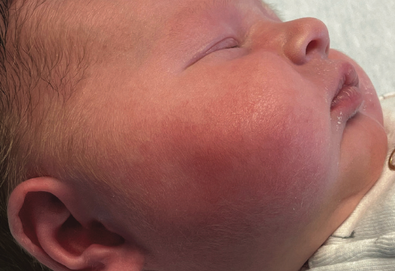 Fever and facial swelling in a neonate