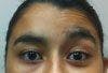 Facial Nerve Palsy in a Female Teenager