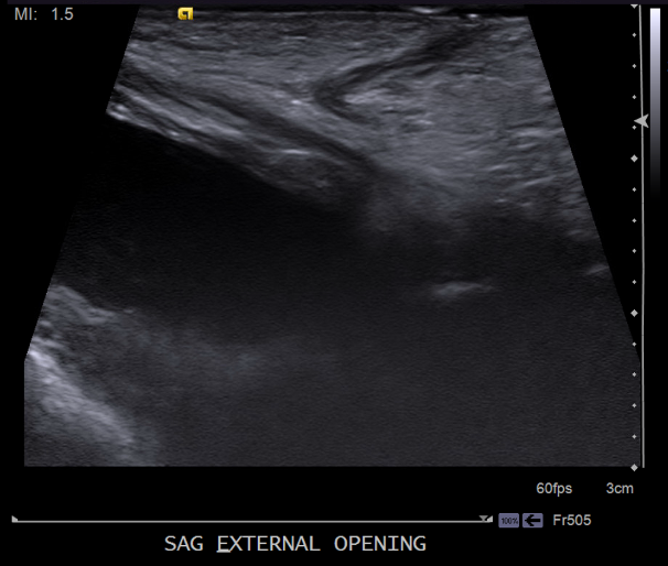 Sagittal ultrasound image of bladder