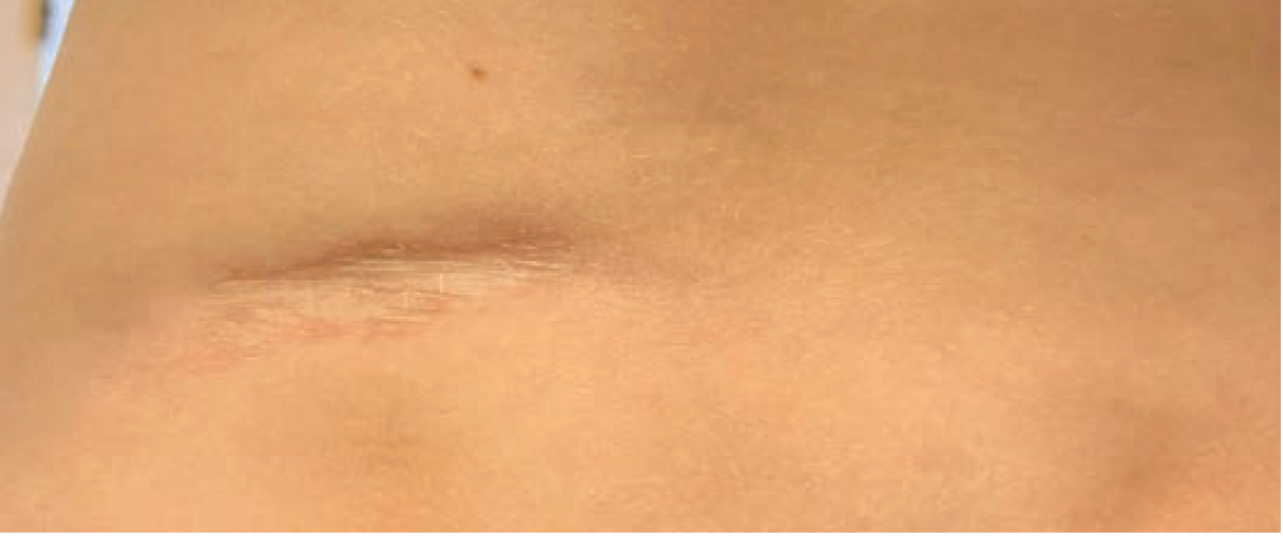 Persistent, atrophic fibrotic plaque that has been developing on patient's lower back for 3 months.