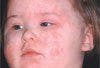 Toddler Who "Caught Psoriasis" at Her Day-Care Center