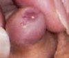 Parameatal Urethral Cyst