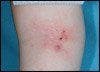 What are these lesions surrounded by eczematous skin that have persisted despite therapy?