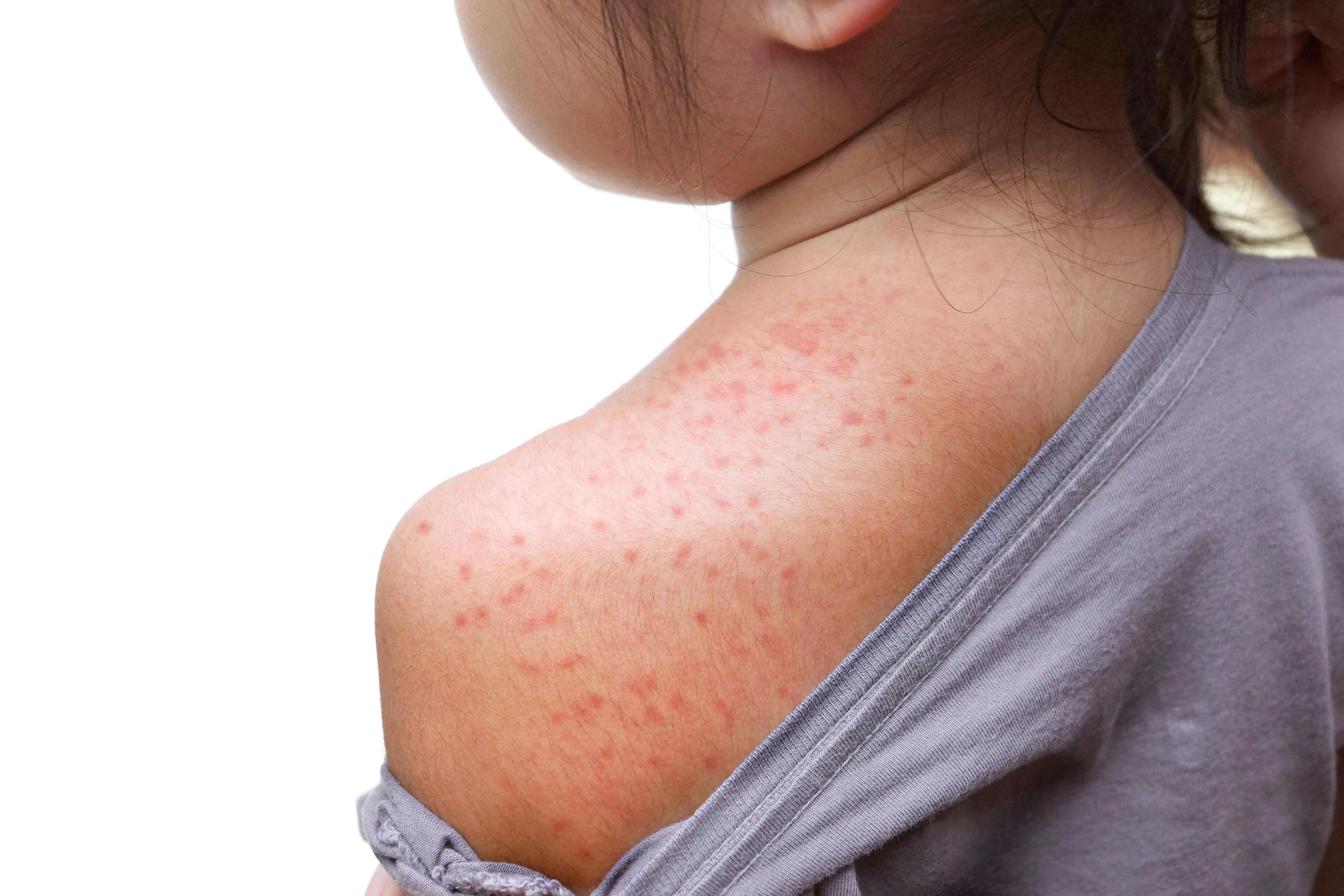 Recent reports of measles in multiple states | Image Credit: © weerapat1003 - © weerapat1003- stock.adobe.com.