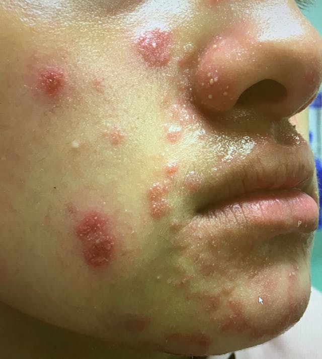 Case of inflammatory acne or something else?