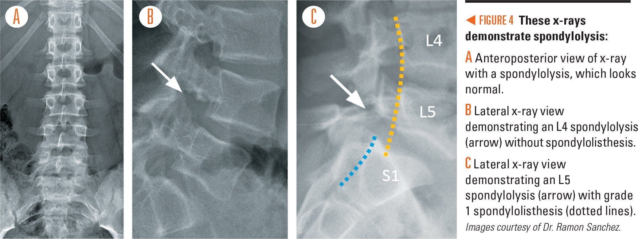 Series of X-rays showing spondylolysis
