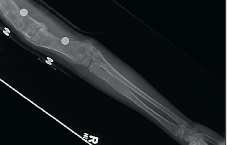 Child with a history of multiple fractures