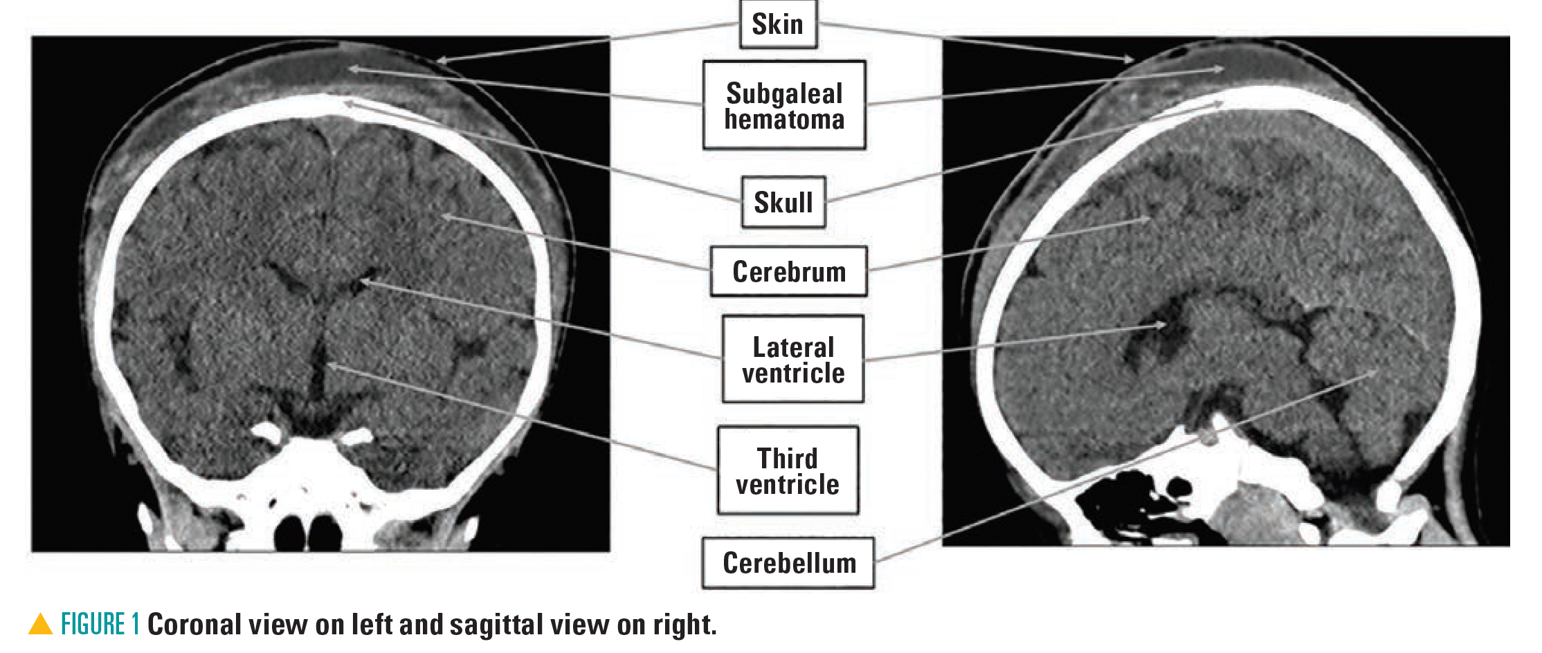 Coronal view on left and sagittak view on right