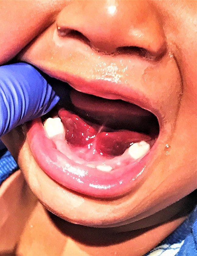 Patient presented with bright red-colored swelling under tongue