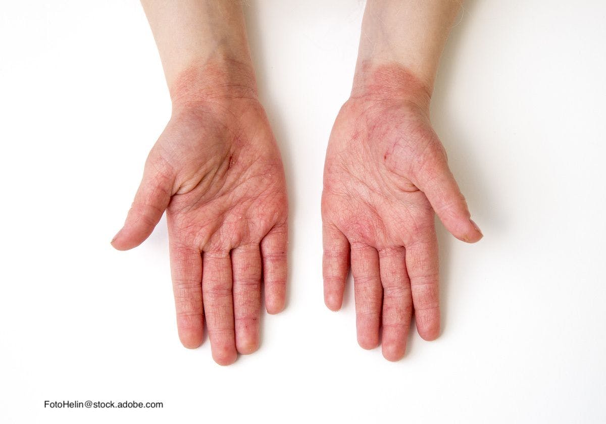 Looking at the safety and efficacy of abrocitinib for treating atopic dermatitis