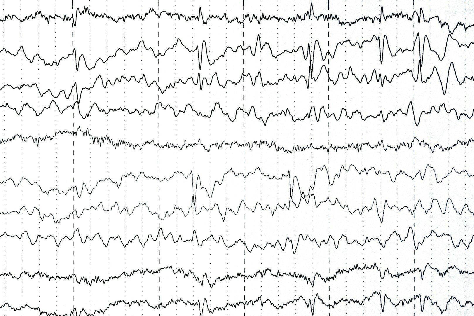 How a web-based model helps predict epilepsy risk