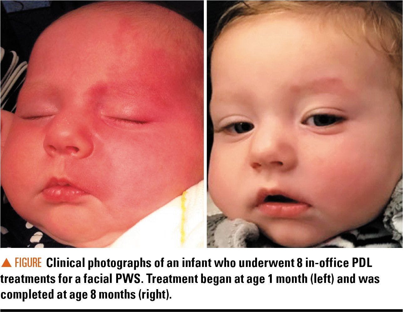 Baby with PWS and after treatment
