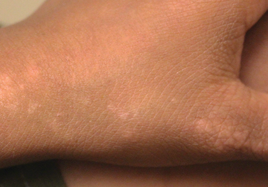 Lichen striatus located on dorsum of patient's hand