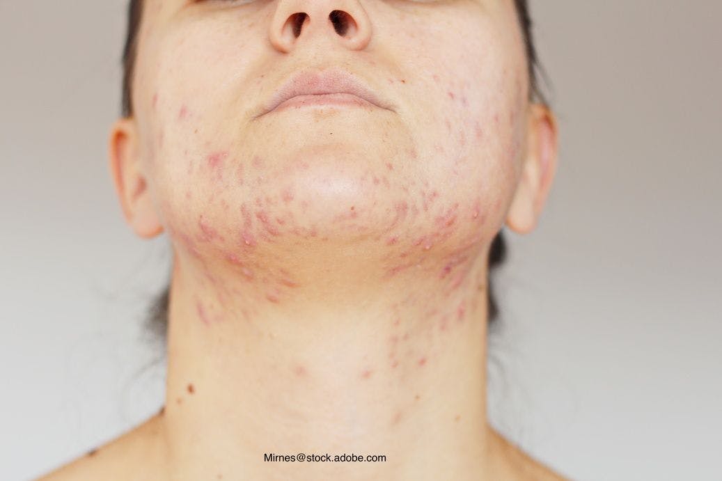 Caregivers worry about impact of severe acne on teens