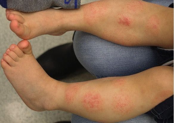 2-year-old boy with atopic dermatitis flare on legs | Image Credit: Author provided