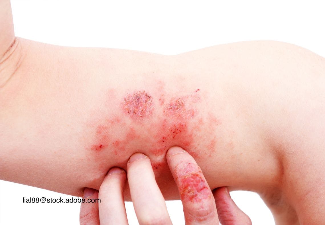 atopic dermatitis on child
