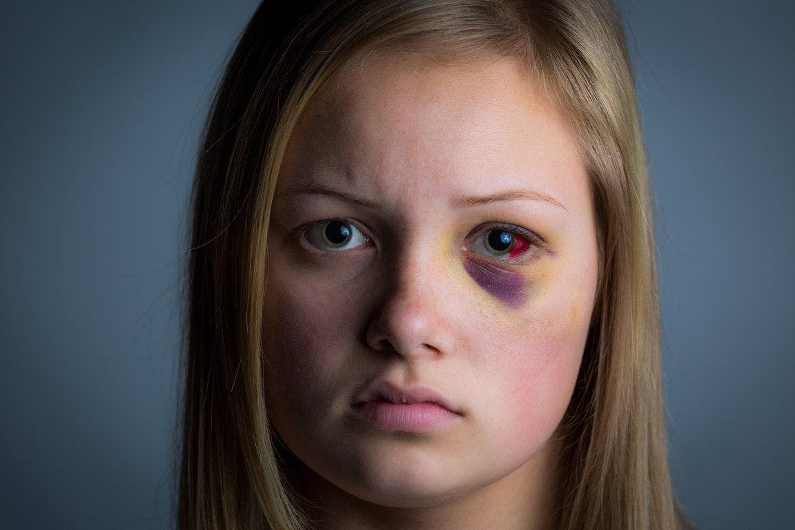 image of teen girl with black eye