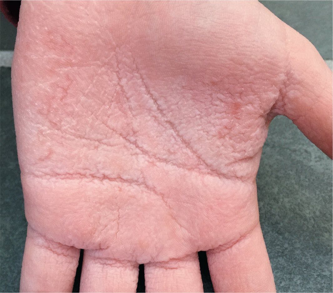 Patient reports exaggerated drinking of the palms with edematous white papule after minutes of exposure to water
