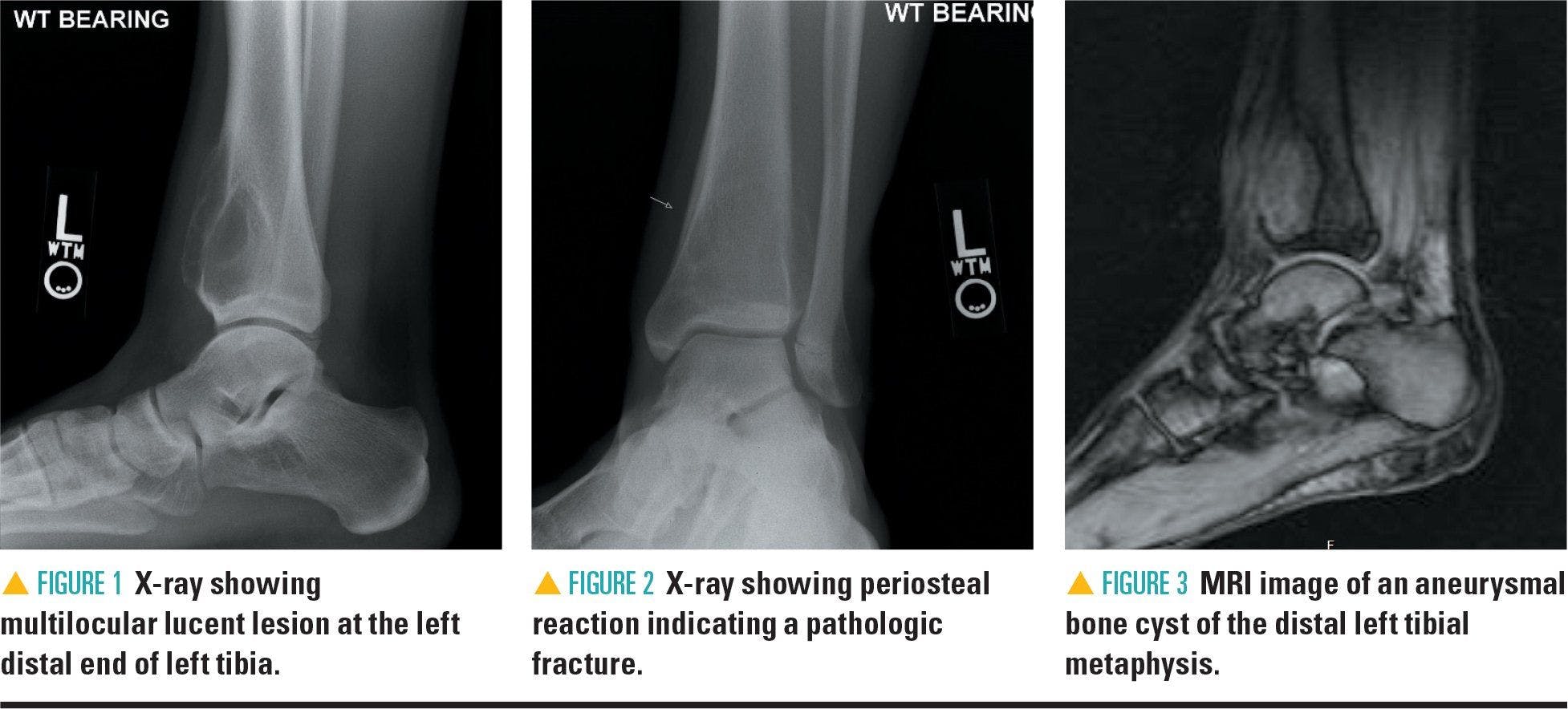 X-rays and MRI showing the patient's ankle