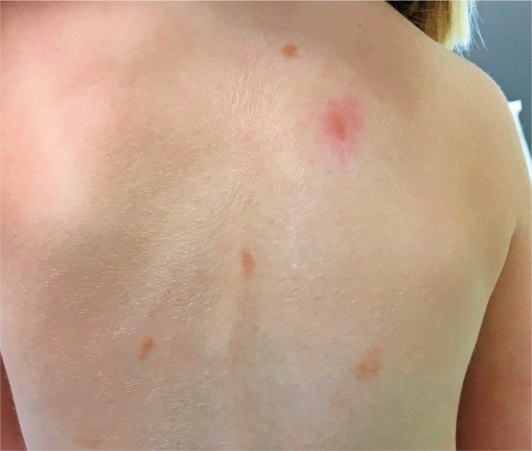 Image of patient with light brown, slightly elevated papules and plaques