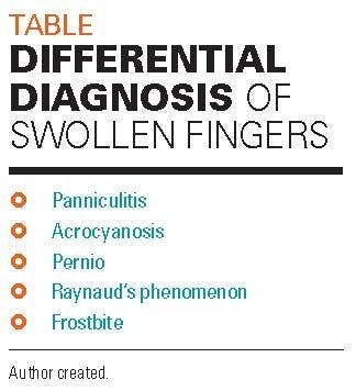 Differential diagnosis of swollen fingers