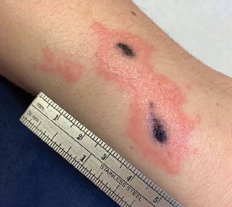 Patient with erythematous plaque with central black discoloration