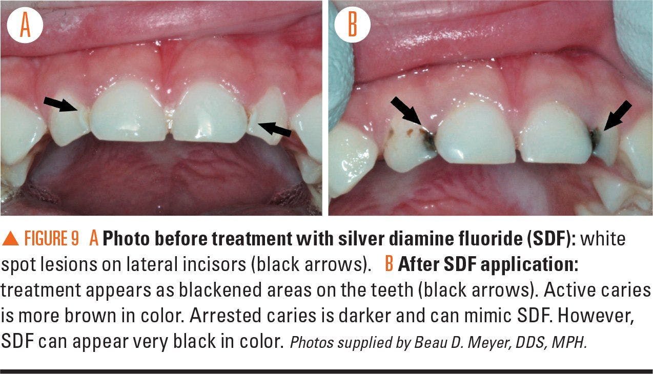 Photos illustrating treatment with silver diamine fluoride
