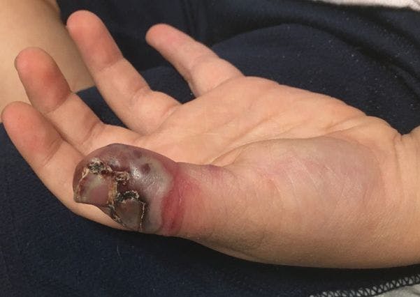 Swollen, purple, blistered thumb leads to diagnosis of herpetic whitlow | Image credit: Author provided