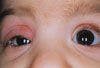 Localized Red Mass on a Toddler's Eyelid