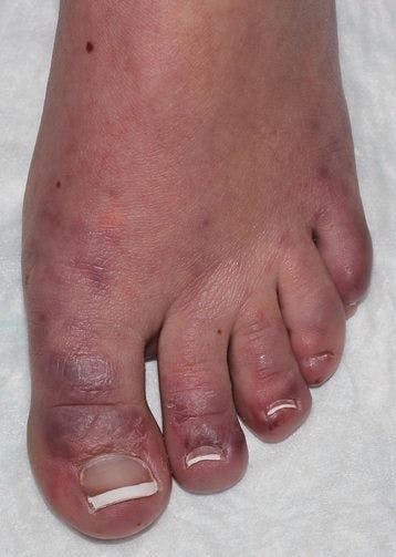 Erythematous-to-violaceous papules and plaques on dorsal toes