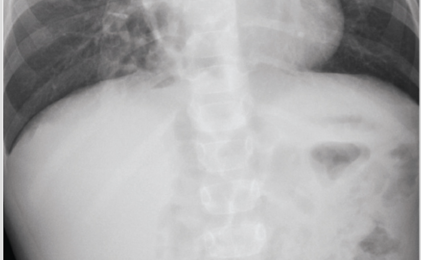 Chronic cough in a 4-year-old boy