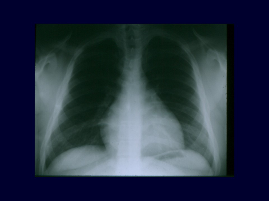 Figure 1: Chest x-ray of 15-year-old boy