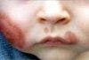 Acute Hemorrhagic Edema of Infancy in an 11-Month-Old Boy