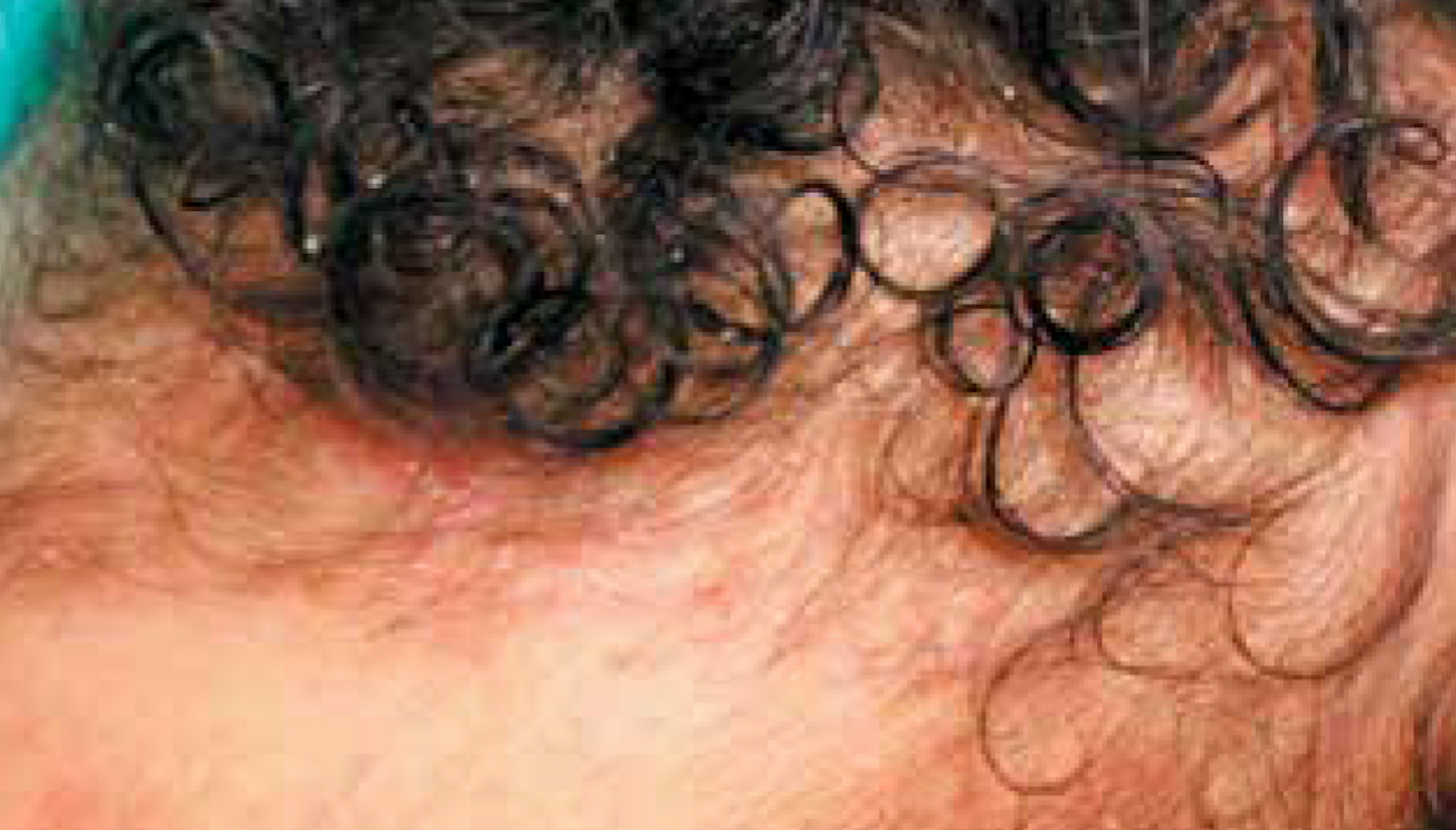 Diffuse rash spreads from infant’s scalp to extremities