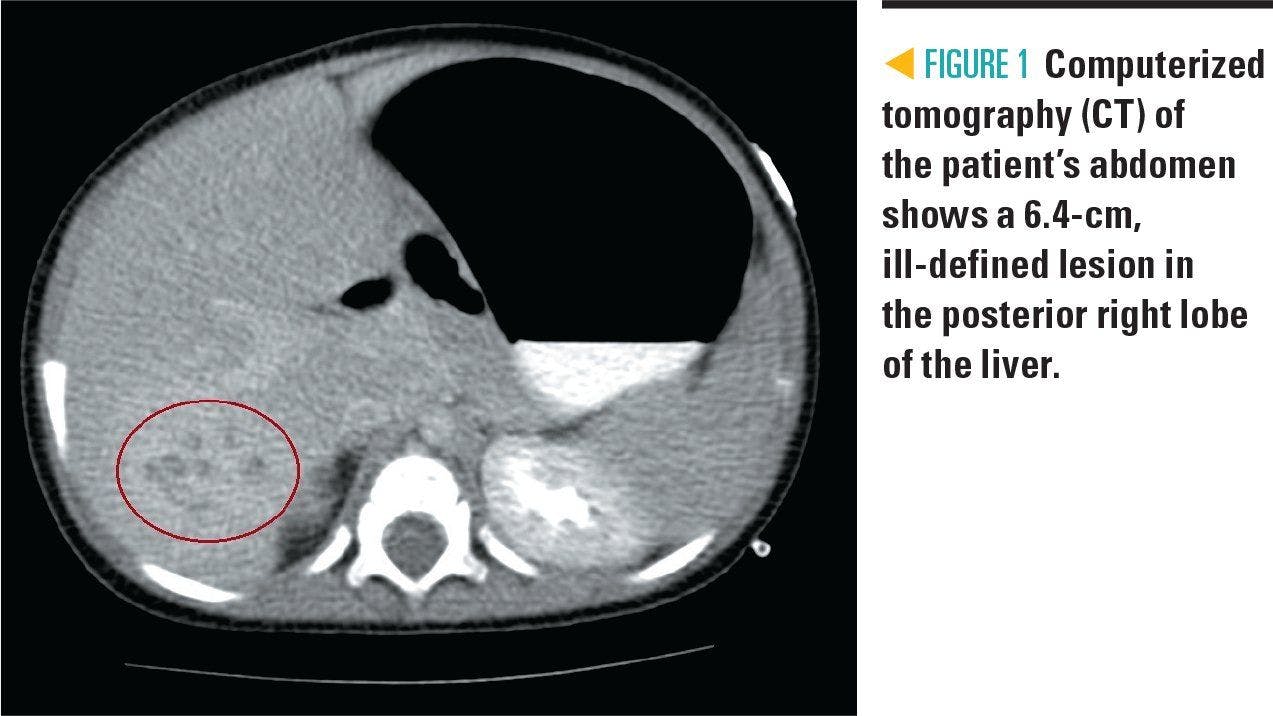 CT of patient's abdomen