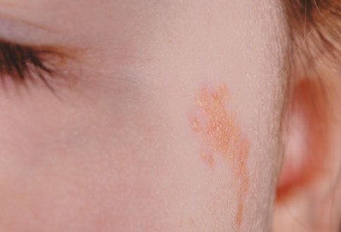 Does this yellow-brown plaque on a young girl's cheek require removal?