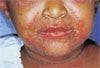 Staphylococcal Scalded Skin Syndrome in a 2-Year-Old Girl
