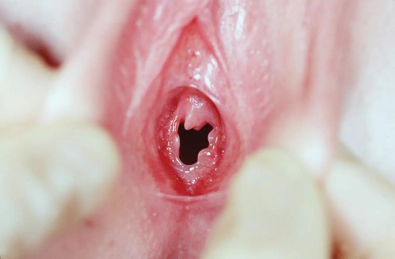 Figure 1. Examination of the vulva of a prepubertal child. (Reported in: Emans SJ, et al. Emans, Laufer, Goldstein's Pediatric Gynecology. 7th ed. Figure 1-6 (B), page 5, Philadelphia, Wolters Kluwer, 2020).