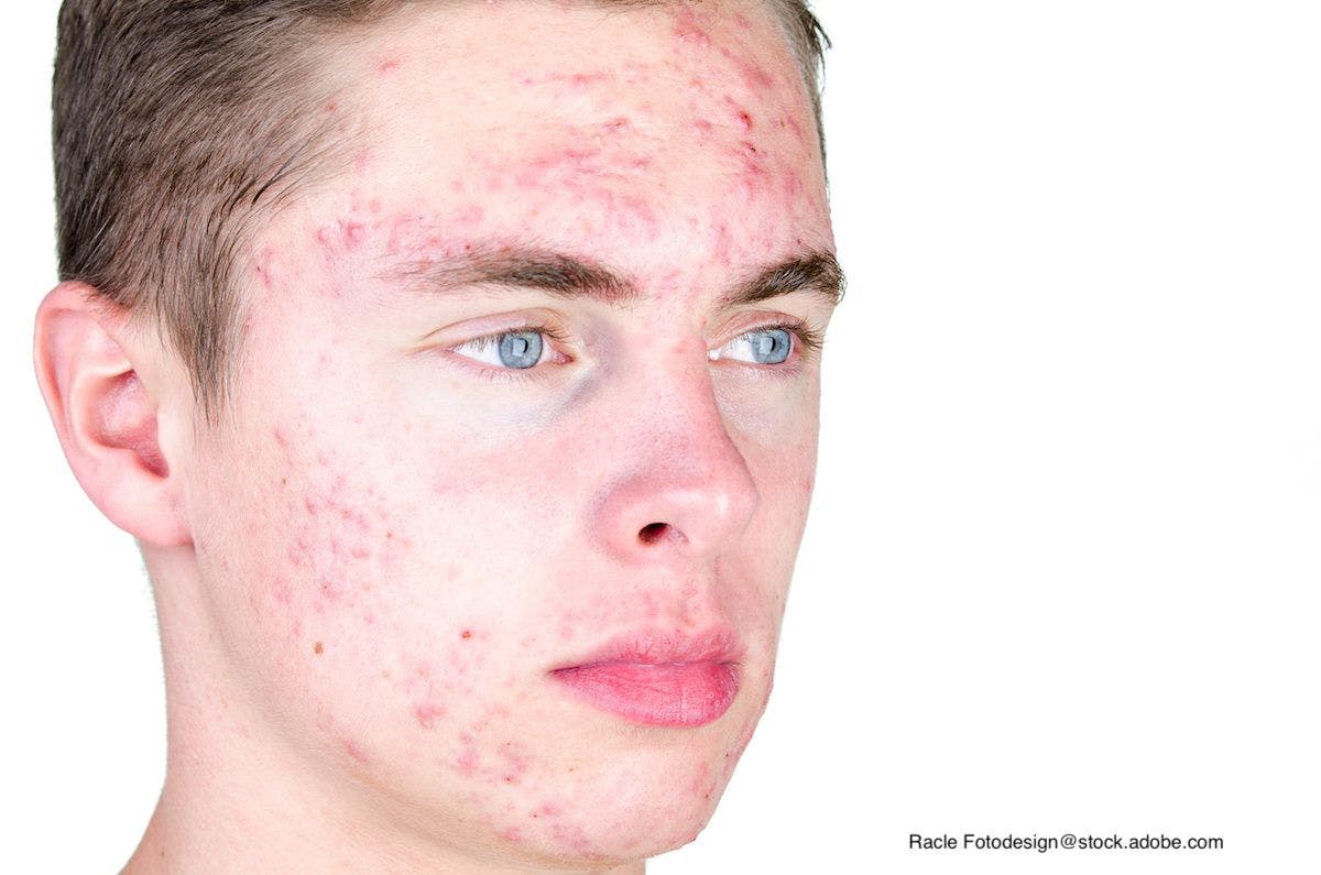 Examining the risk of bacterial resistance tied to systemic antibiotic use for acne