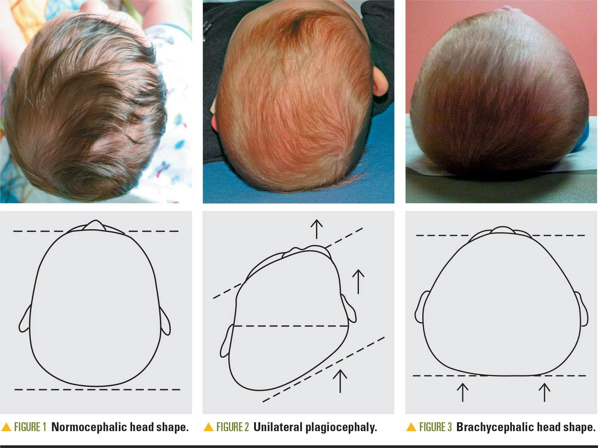 Normocephalic head shape, unilateral plagiocephaly, brachycephalic head shape