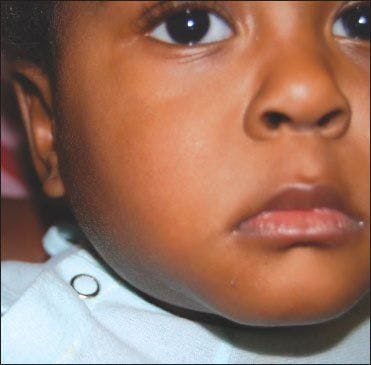 Fever and Neck Swelling in a Toddler With Growth Delay