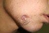 Teen With a Painful “Hole” in His Cheek